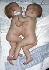 Siamese-twins-7_blog-full